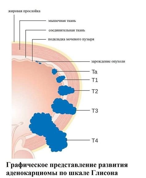 Прогноз С61 ЗНО предстательной железы