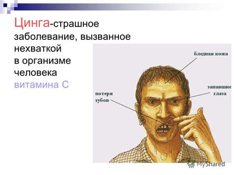 Проект 4 класс: причины заболевания цингой