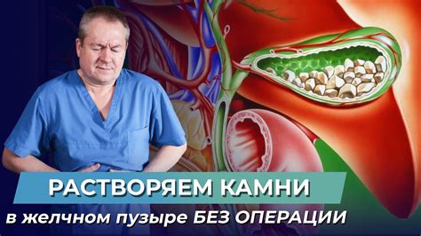 Профилактика колики в желчном пузыре