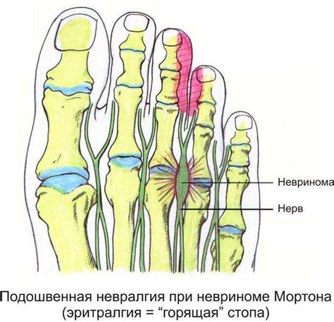 Профилактика невромы Мортона: что можно сделать?