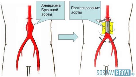 Профилактика уплотнения аорты на флюорографии