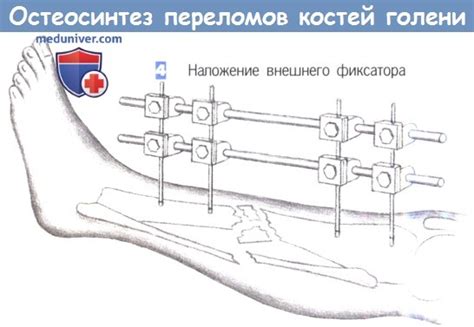 Процесс выполнения остеосинтеза голени штифтом