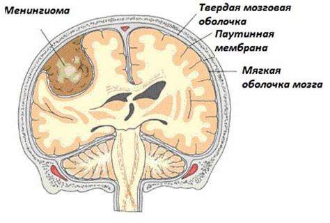 Пустое турецкое седло в головном мозге