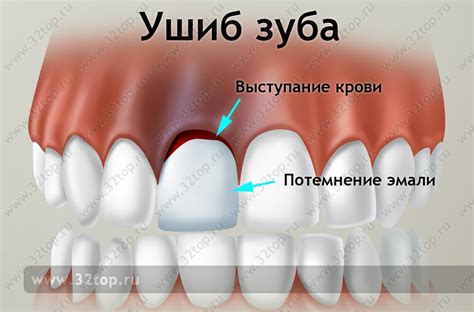 Разбор сновидения: поврежденный зуб без присутствия крови, расположенный в верхней части полости рта