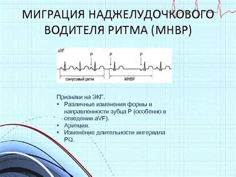 Различные причины возникновения наджелудочкового ритма