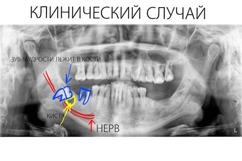 Разнообразные толкования снов о потере зуба без боли и кровотечения