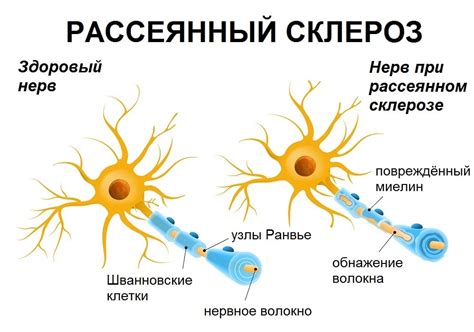 Рассеянный склероз у молодежи