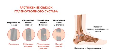 Растяжение связок на шее: как поступить?