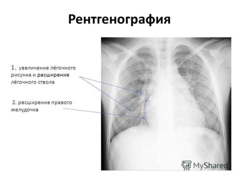 Расширение легочного ствола