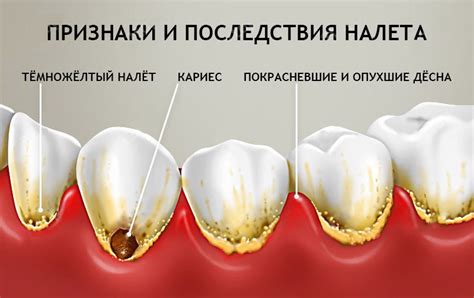 Расшифровка снов о полости зубной с пробоиной и кариесом