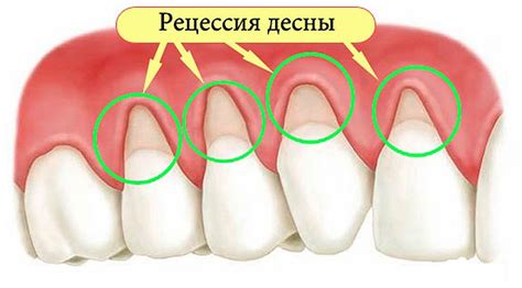 Реальные причины, вызывающие потерю зуба без крови и ощутимой дискомфорта