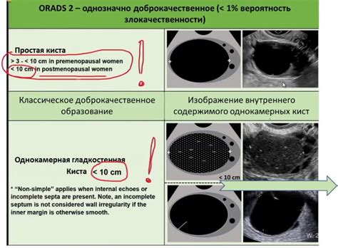 Рекомендации для профилактики ОРАДС 2 яичника