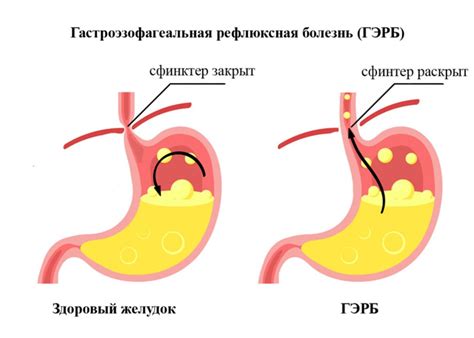 Рекомендации для родителей при изжоге у ребенка в 10 лет