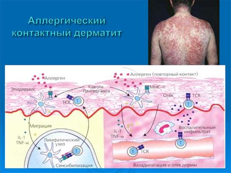 Рецидивирующие инфекции и аллергические реакции