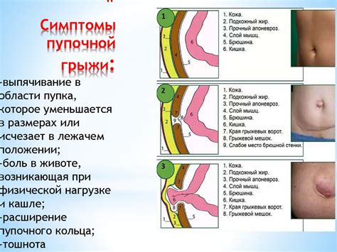 Роль грыжи пупочной кольцевой в аномально повышенном выделении жидкости из пупка