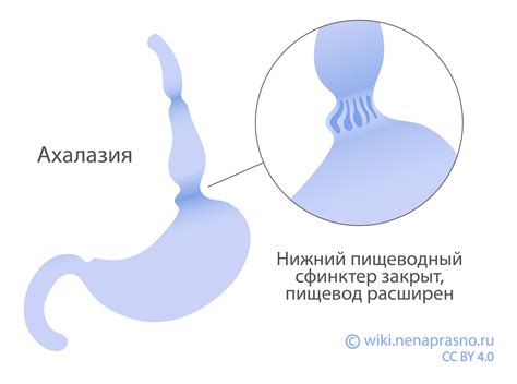 Роль пищевода при нарушениях