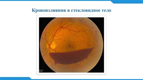 Роль роговицы и хрусталика в процессе фокусировки изображения