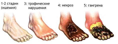 Сахарный диабет и ампутация ноги: последствия и их влияние на жизнь пациента