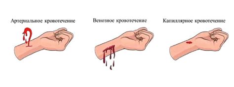 Связь кровотечения фонтаном в сновидении с возможной конфликтной ситуацией