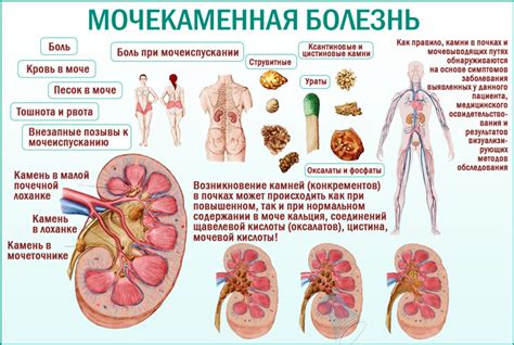 Связь между кровью в моче и мочекаменной болезнью