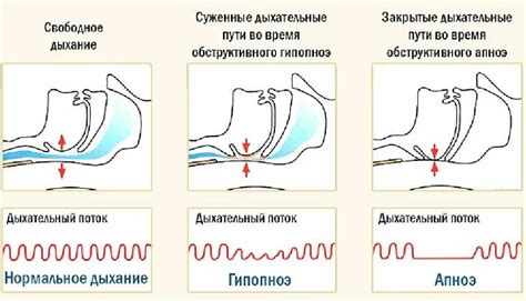 Связь между немотой во сне и нарушениями сна