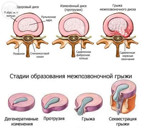 Сгибательная грыжа диска позвоночника