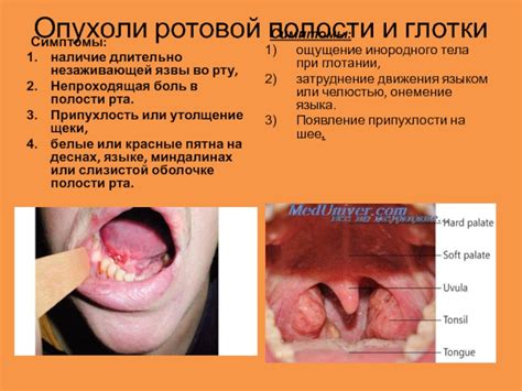 Символическое значение образа находящейся в рту опухоли во сне