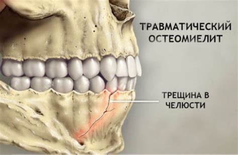 Симптомы, вызывающие прижатие челюстей