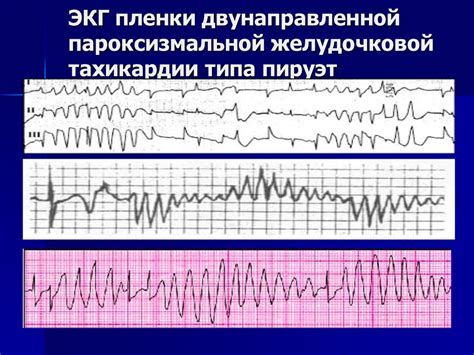 Симптомы аритмии типа пируэт