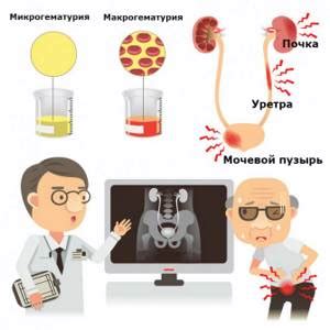 Симптомы гематурии у мужчин пожилого возраста