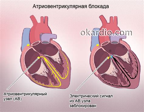 Симптомы гибернакулярного блока