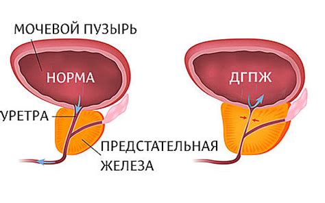 Симптомы гиперплазии простаты 1 степени