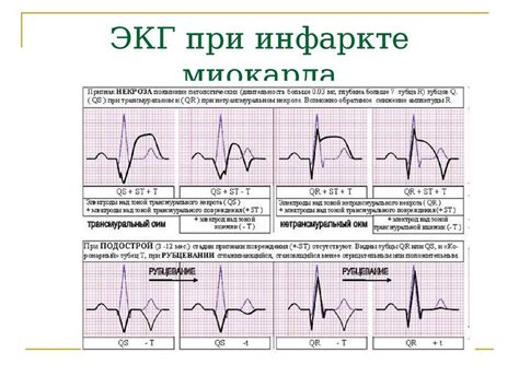 Симптомы гипоксии миокарда на ЭКГ