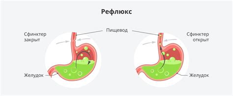 Симптомы заброса желчи в пищевод