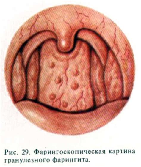 Симптомы и диагностика задней стенки горла в бугорках