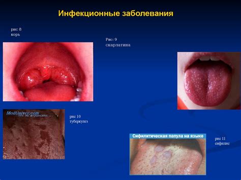 Симптомы и причины изъязвления слизистой оболочки полости рта