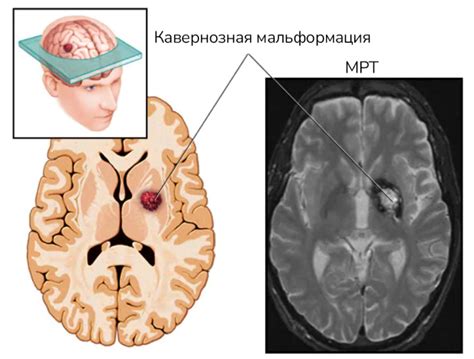 Симптомы каверномы ствола головного мозга