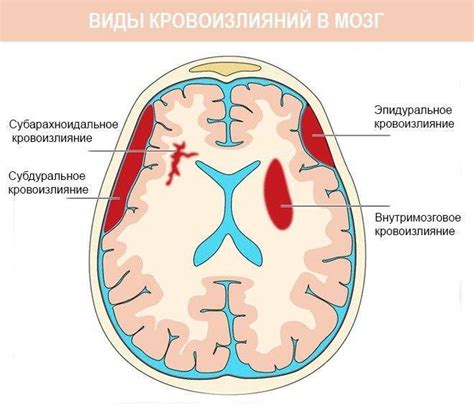 Симптомы кровоизлияния в мозг у новорожденных