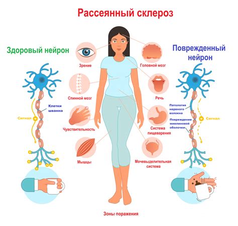 Симптомы маразма и склероза