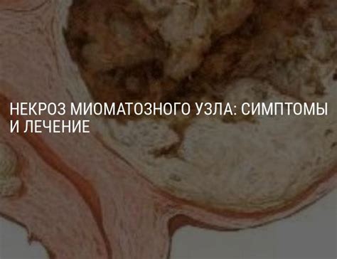 Симптомы миоматозного узла 2 типа