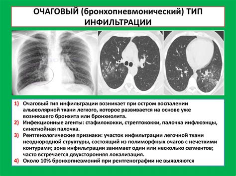 Симптомы мозаичной пневматизации легких