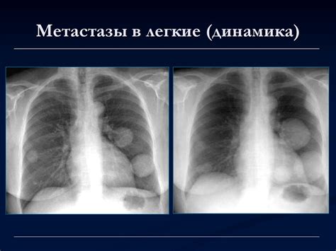 Симптомы обнаружения очага в легких на рентгене