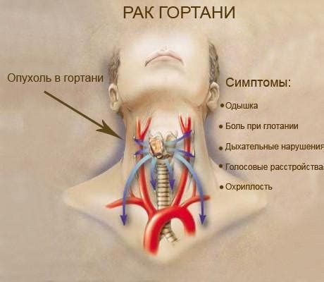 Симптомы опухоли в горле