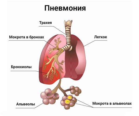 Симптомы пневмонии у детей