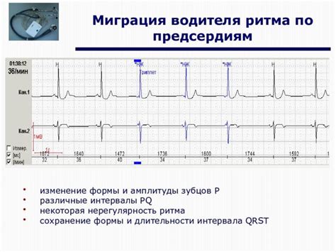 Симптомы предсердного ритма: что нужно знать?