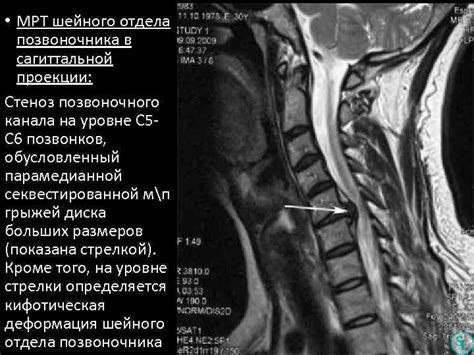 Симптомы стеноза позвоночника шейного отдела