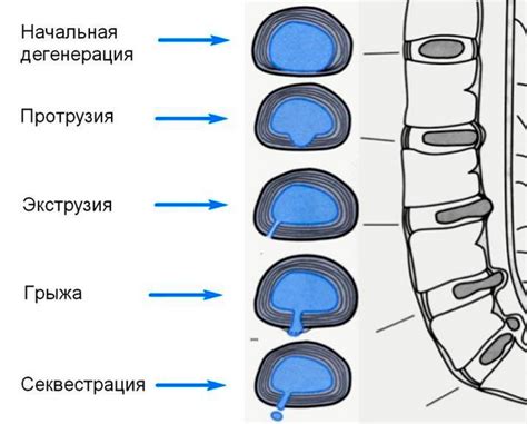 Симптомы экструзии поясничных межпозвонковых дисков