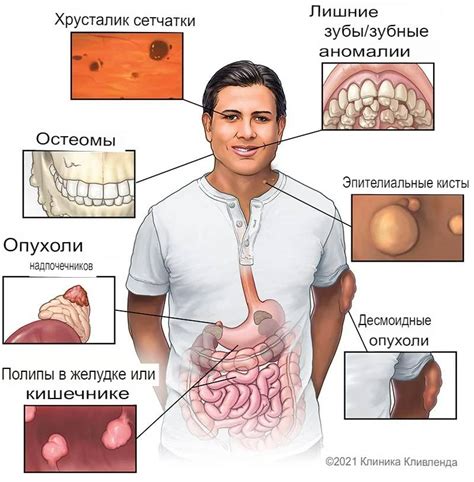 Синдром Гарднера