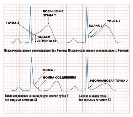 Синдром ранней реполяризации желудочков: симптомы и диагностика