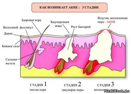 Сладкое и прыщи: какая связь между ними существует?